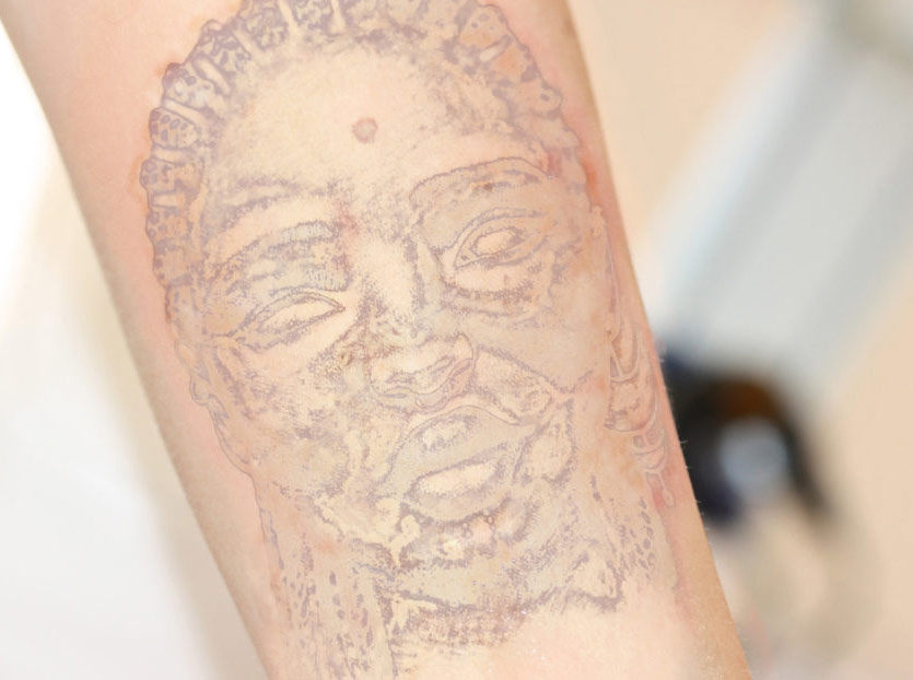 Tattooentfernung Kopf Behandlungsprozess