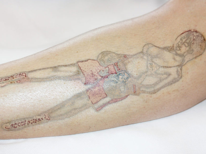 Tattooentfernung Behandlungsfotos Boxerin Behandlungsprozess