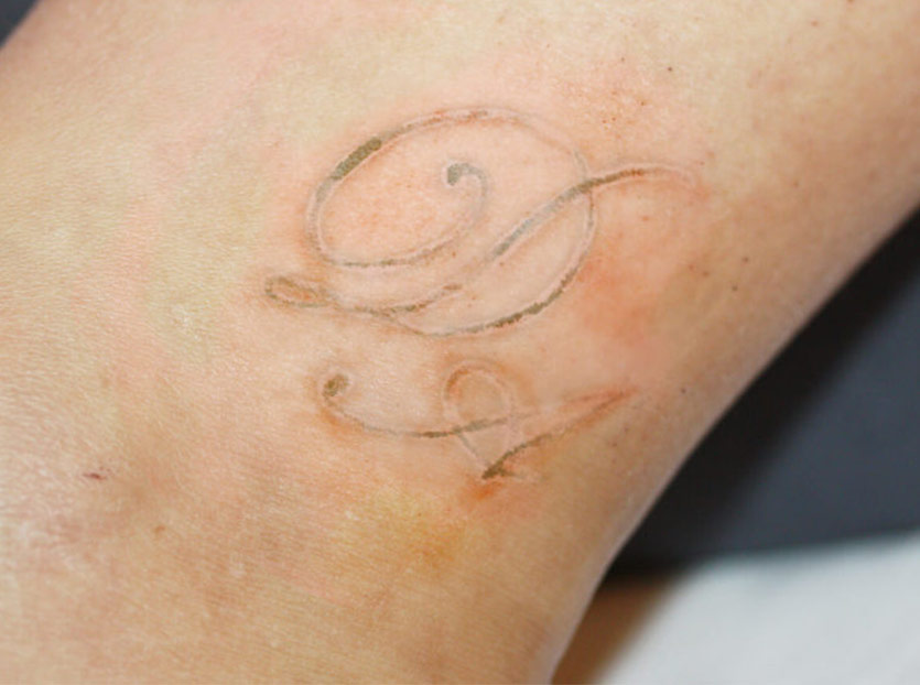 Foto Tattooentfernung Initialien Behandlungsvortschritt