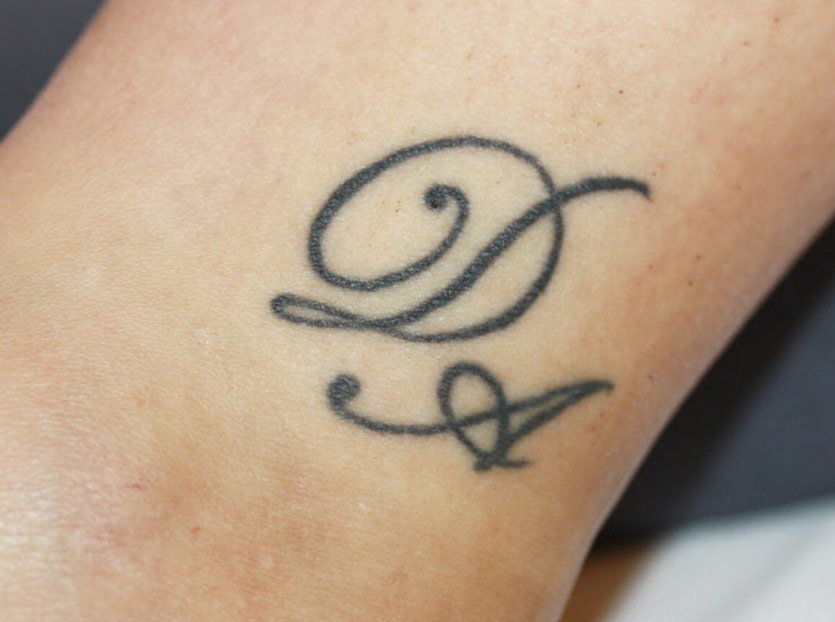 Foto Tattooentfernung Initialien Anfang