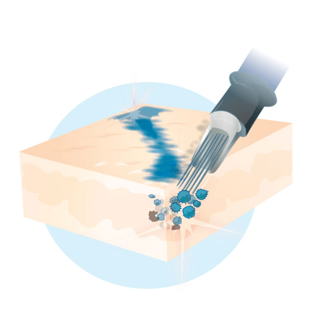 Cover-up Stechen