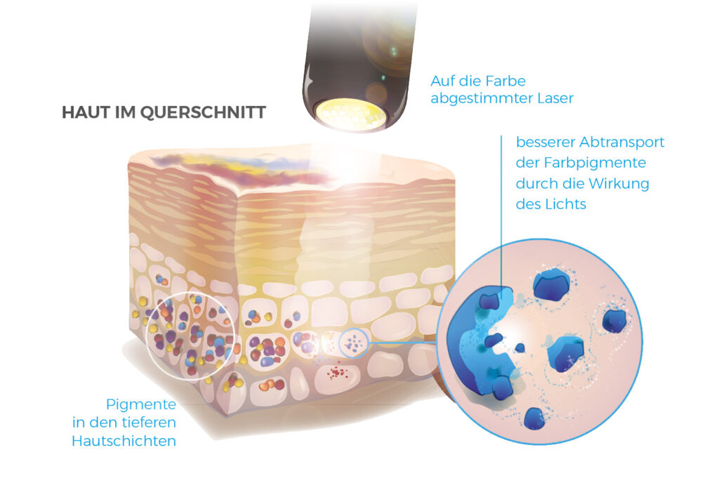 Infografik Tattooentfernung