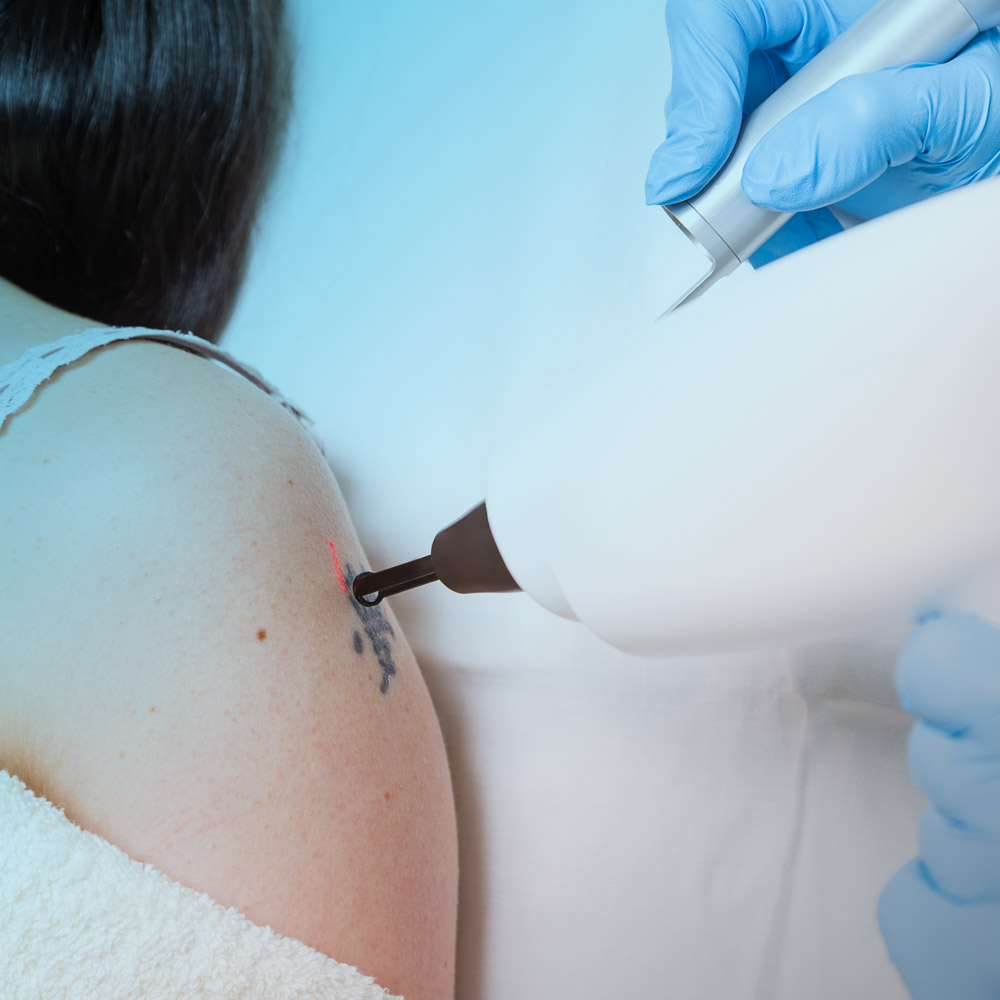 Foto Behandlung Tattoo