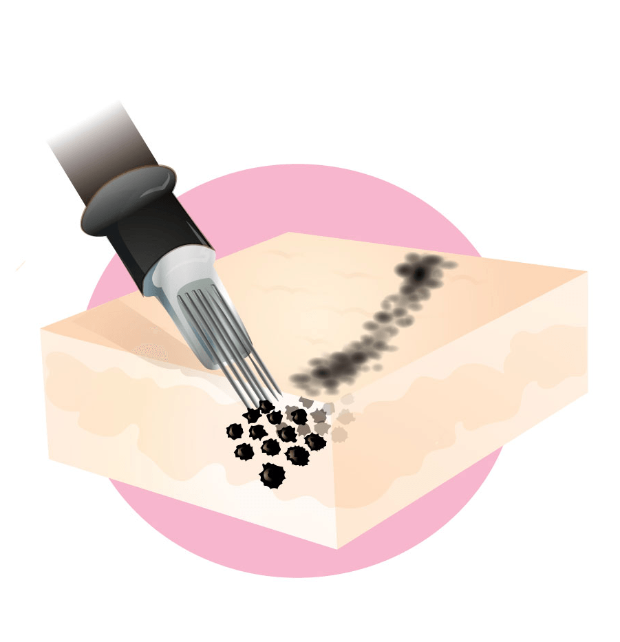 Tattowierung