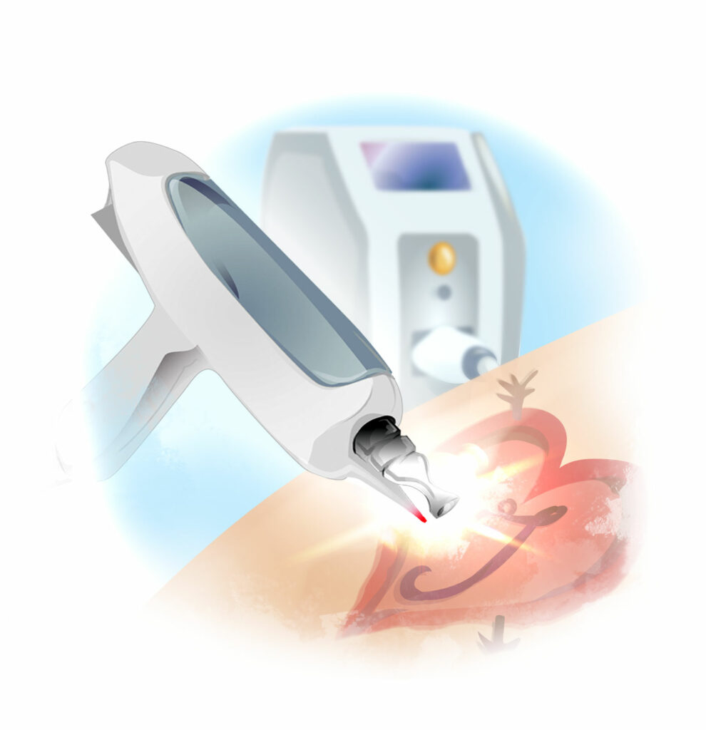 Illustration YAG Laser